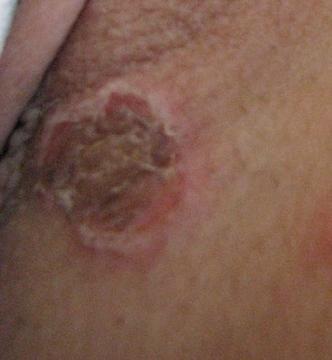 Bolestivé ranky na pohl.orgánoch