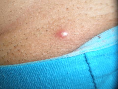 Divný pupínek/vřed