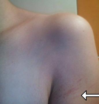 Modřinky/podlitinky na paži